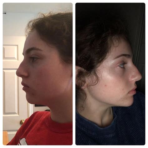 nose subliminal results reddit.